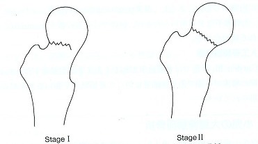 大腿骨ステージ１.1.jpg