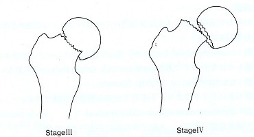 大腿骨ステージ３.1.jpg