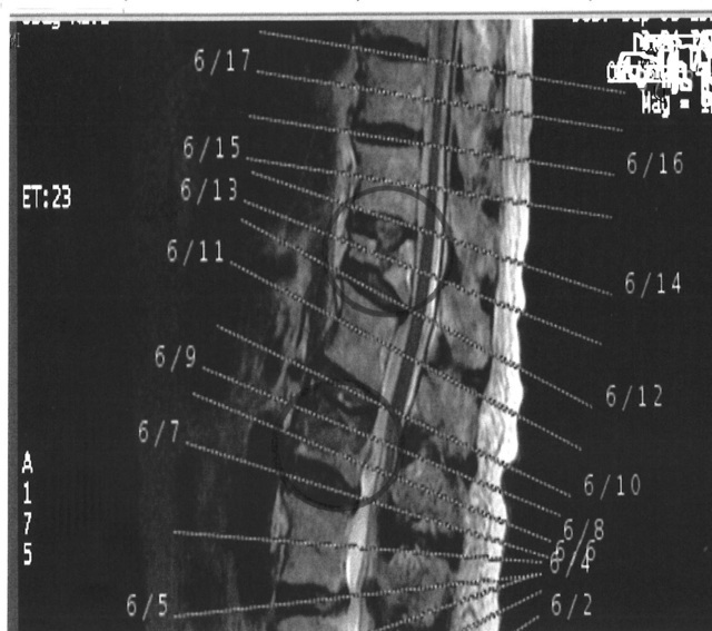 第 三 腰椎 圧迫 骨折